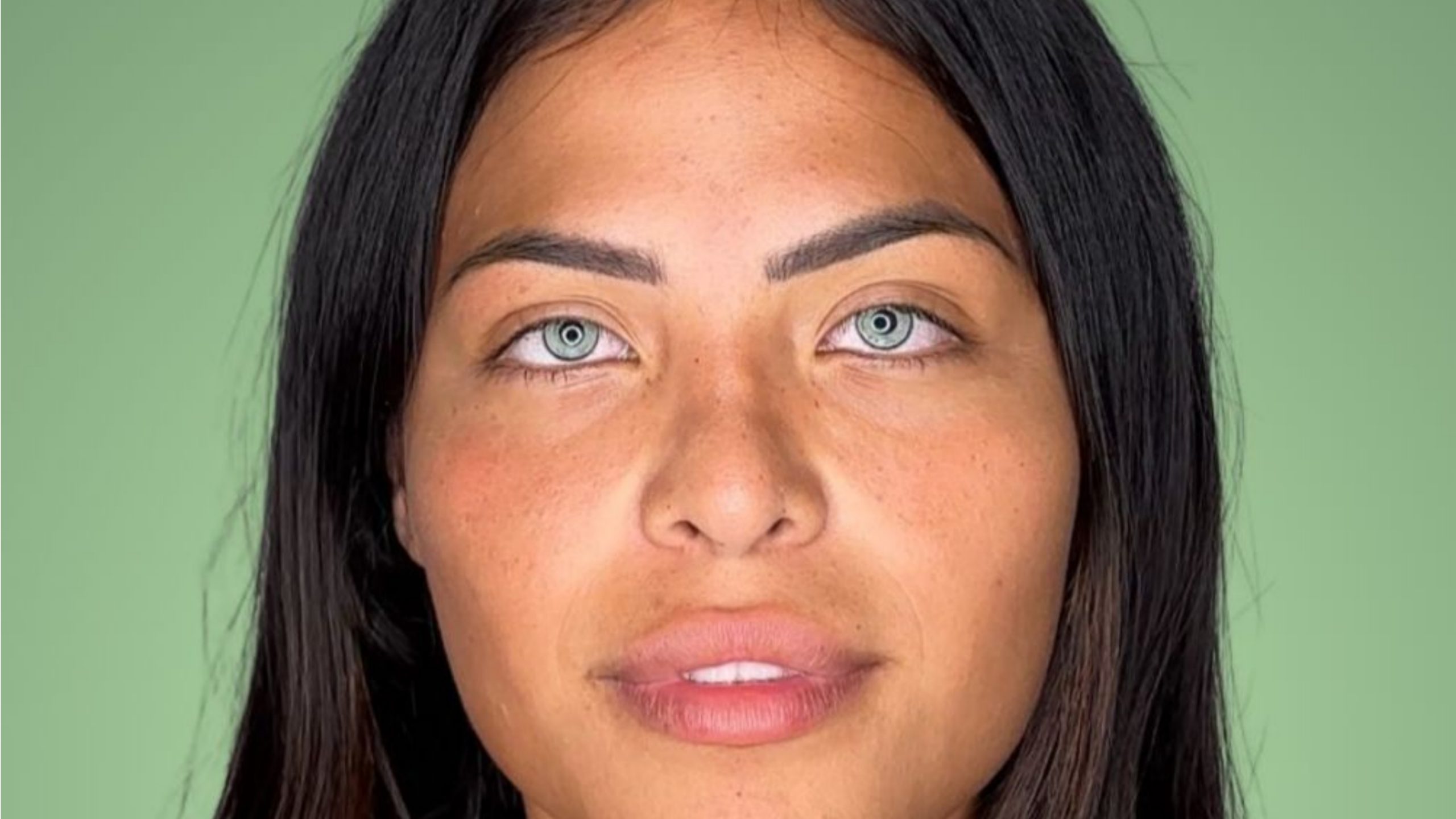 Résultat de kératopigmentation BIOCHROMAEYES®